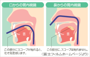 経鼻内視鏡説明